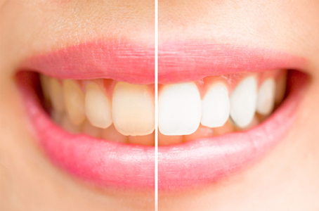 Before and After Teeth Whitening Service Dentist Surrey BC